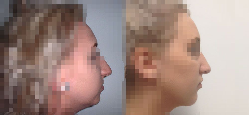 Kinnkorrektur vorher und nachher